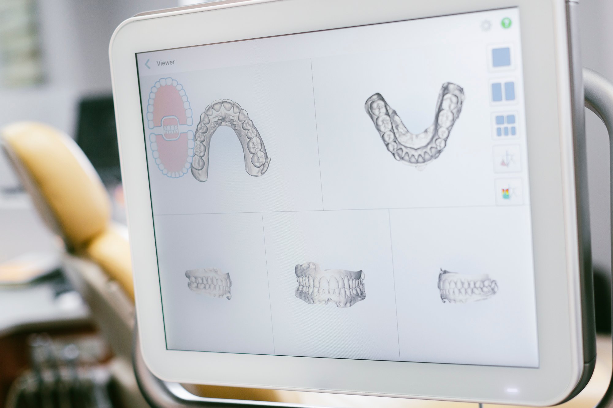 How Braces Work to Straighten Your Teeth - Digital Scan