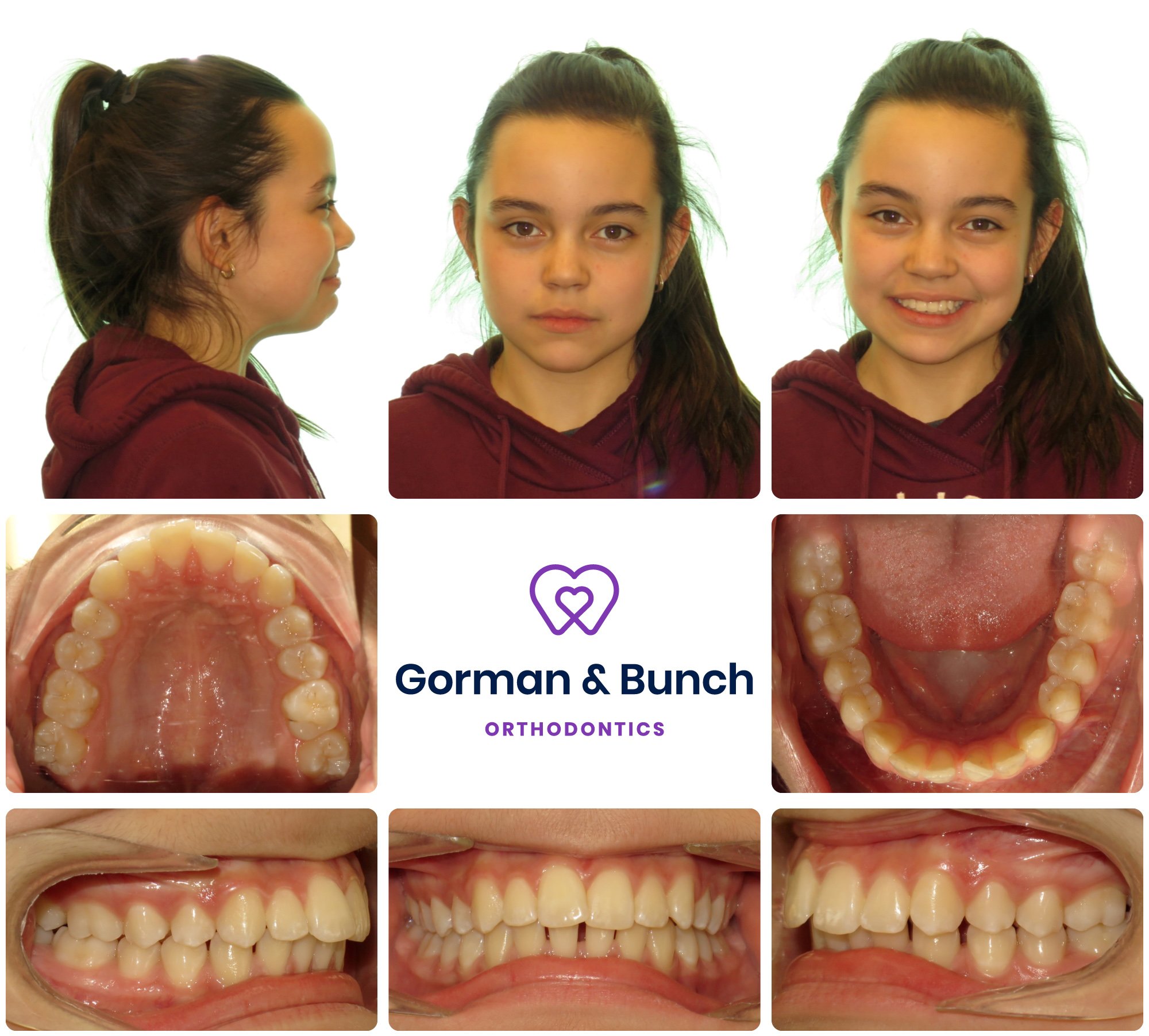 Invisalign Before and After Stories With Our Patients - Gorman and