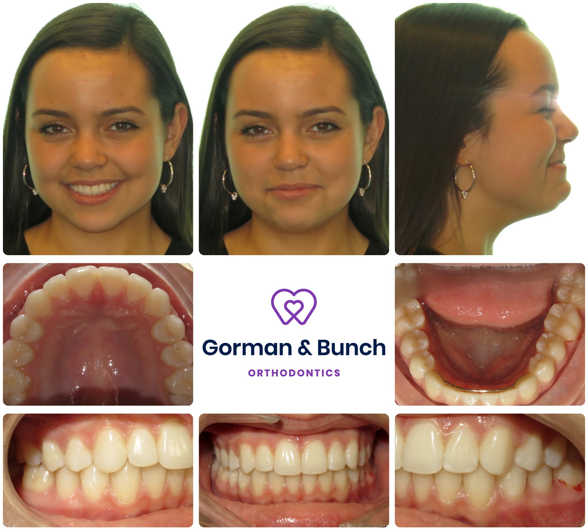 invisalign before and after crossbite