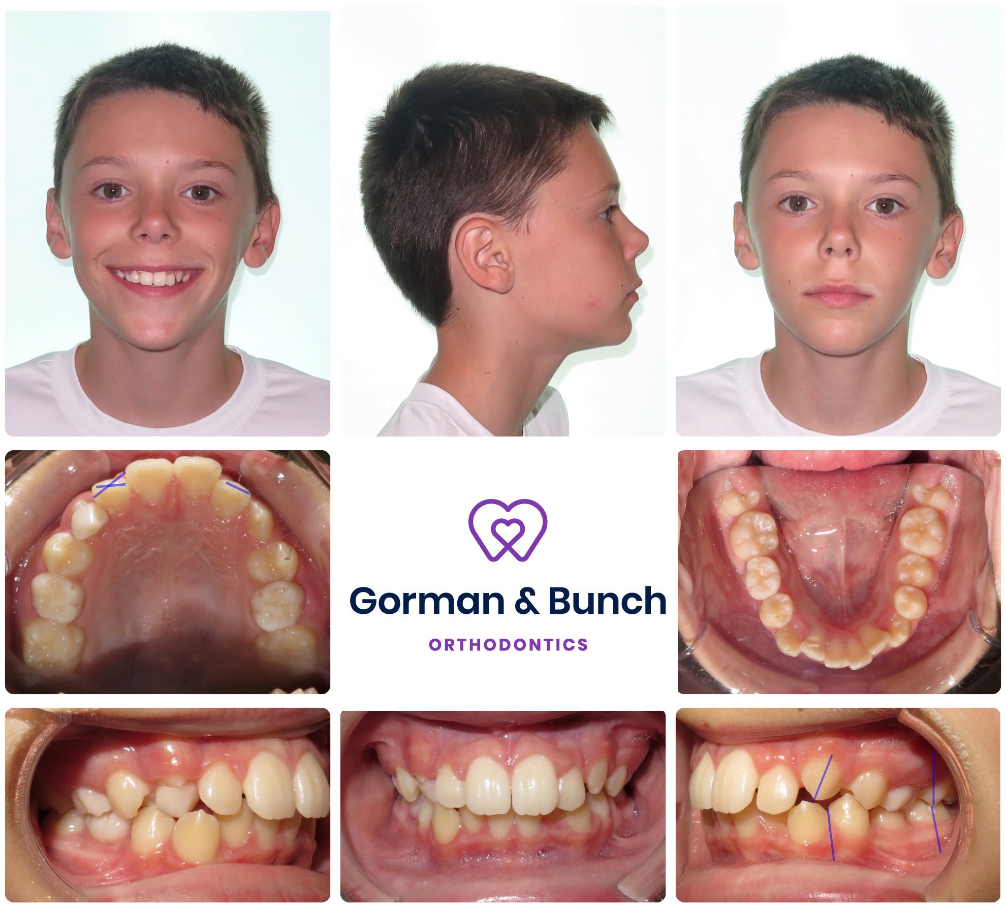 Invisalign Before and After  Dental Treatment Before and After Photos