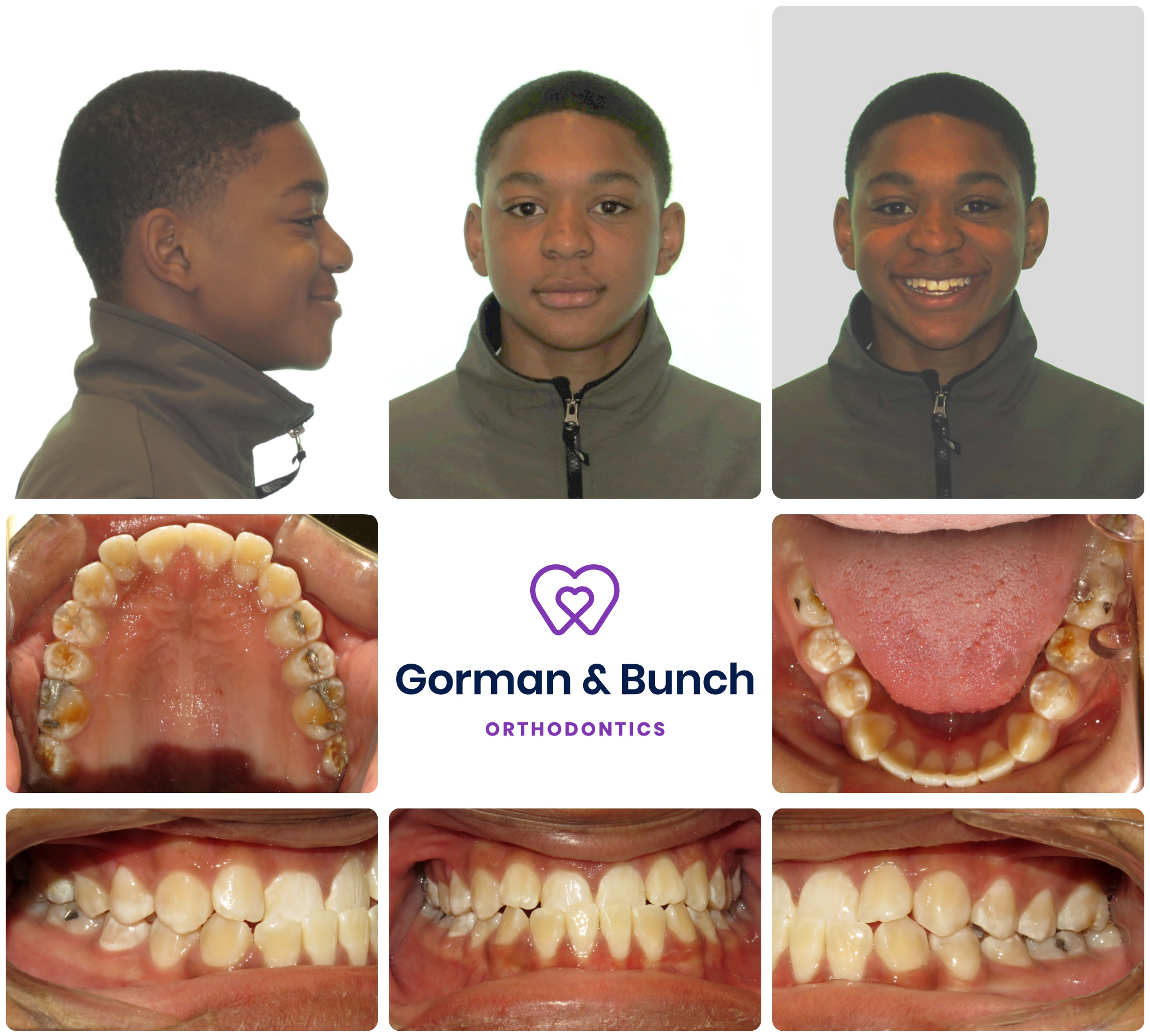 Teen Invisalign and Braces - Before and After