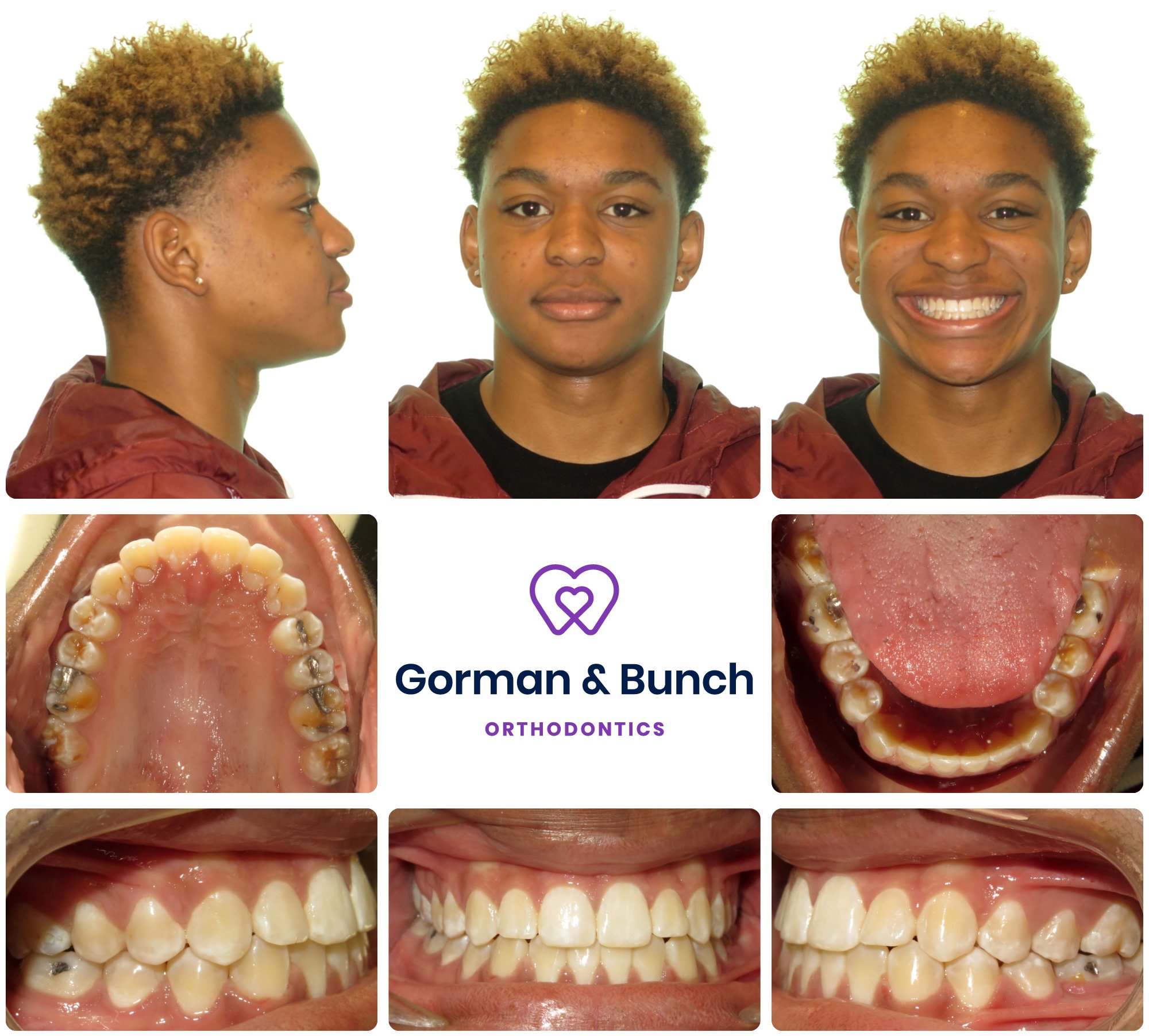 Braces Before and After / Invisible Aligners Before and After